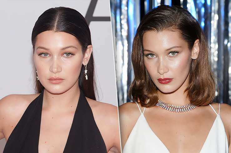 Фото до&nbsp;после пластики щек