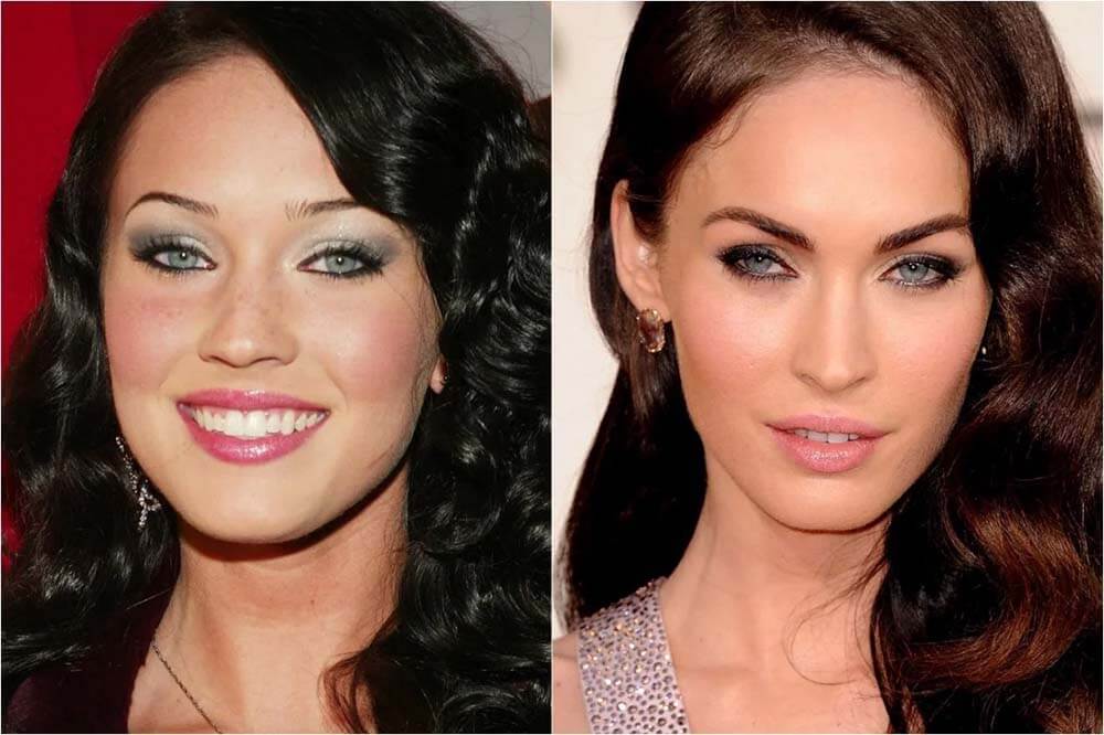 Звездная пластика скул фото до после