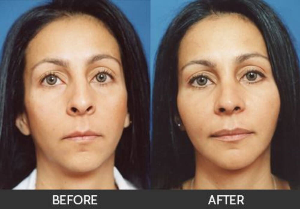 Протезирование скул фото до после