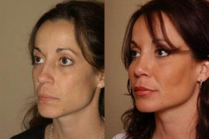 Липофилинг скул фото до после