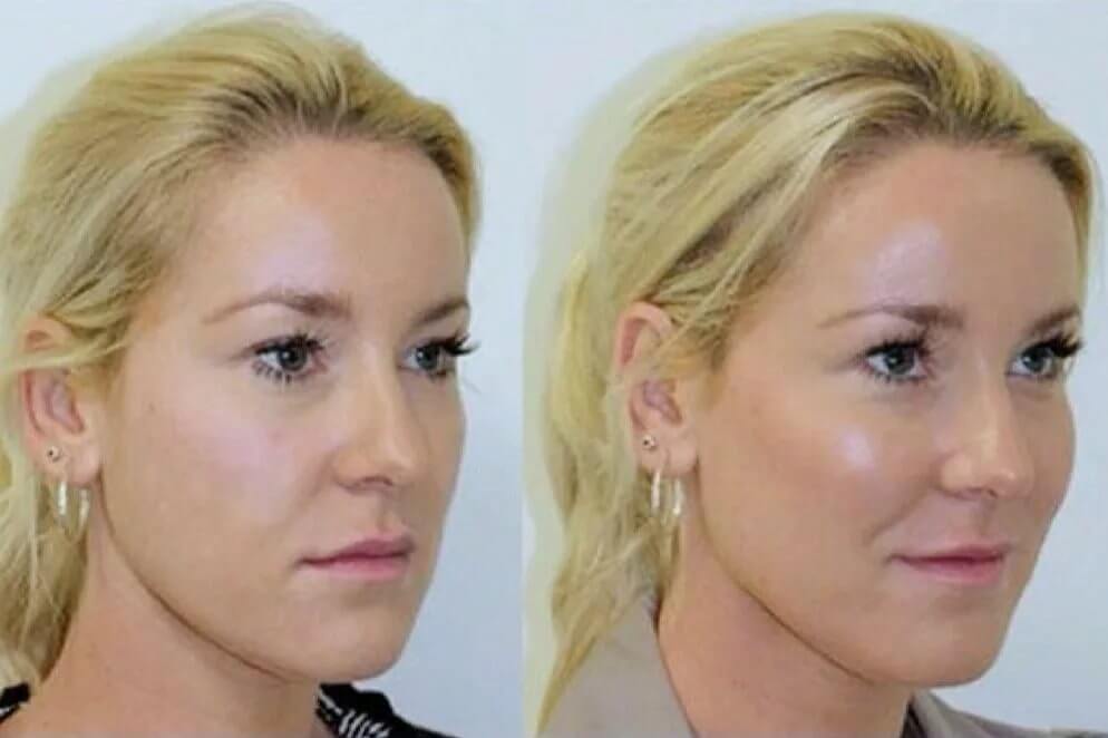 Контурная пластика скул фото до после