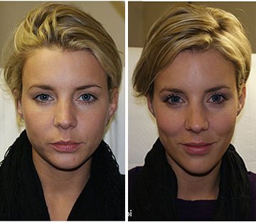 Контурная пластика скул фото до и после