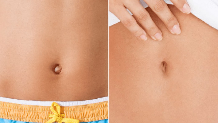 Фото до после коррекции пупка: изменение выпуклой формы