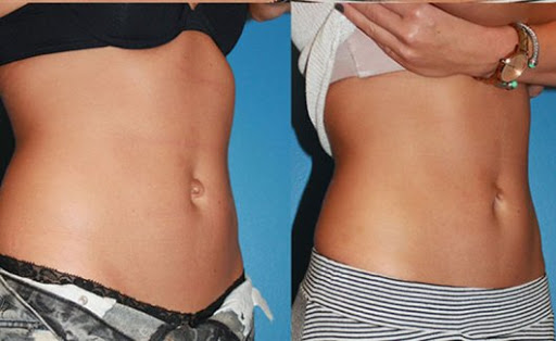 Фото до после коррекции пупка