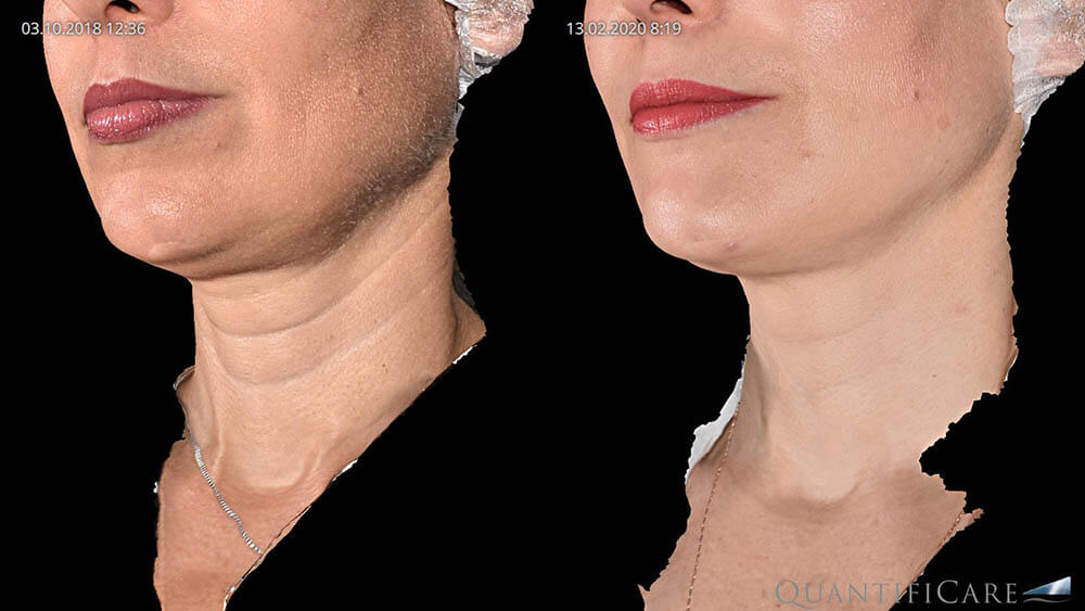 Платизмопластика шеи фото до&nbsp;после