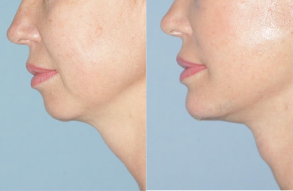 Фото до&nbsp;после подтяжки шеи