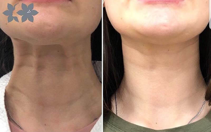 Комбинированная пластика шеи фото до&nbsp;после