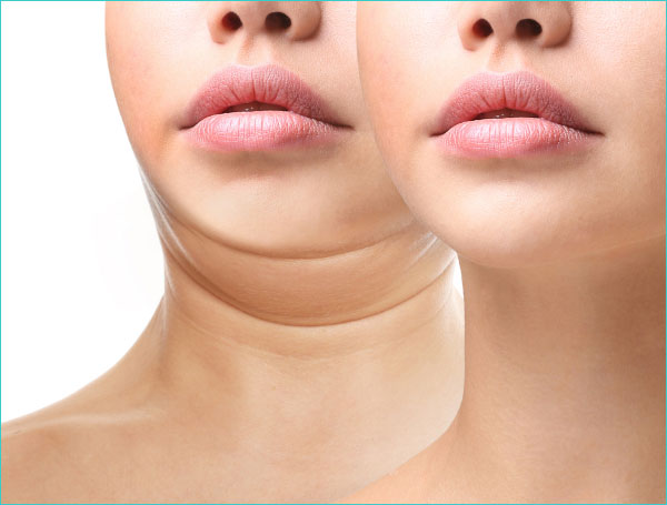 подтяжка подбородка