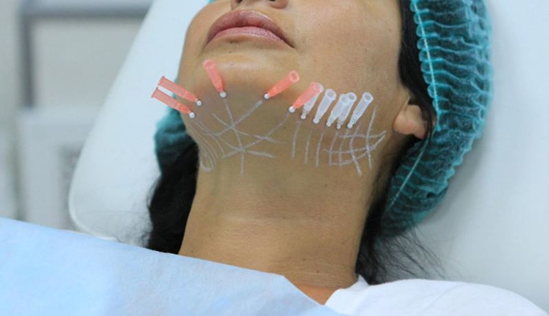 ните для&nbsp;подтяжки нижней трети лица