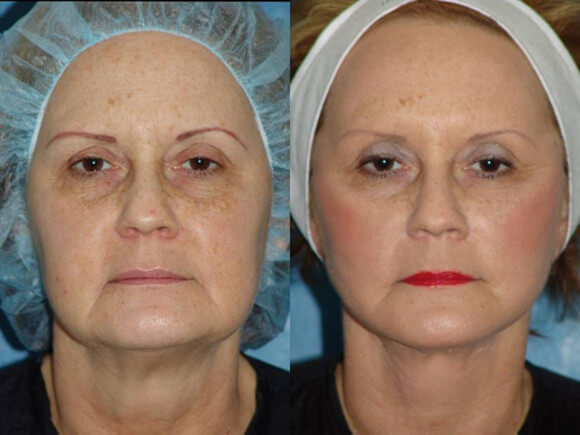 Фото до после безоперационного омоложения