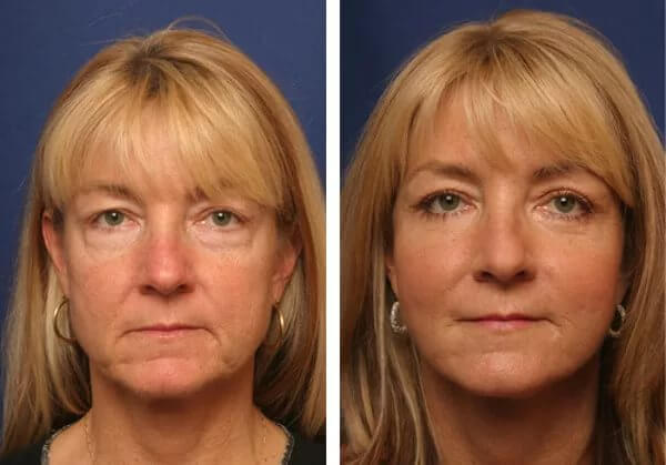 Спейслифтинг фото до после