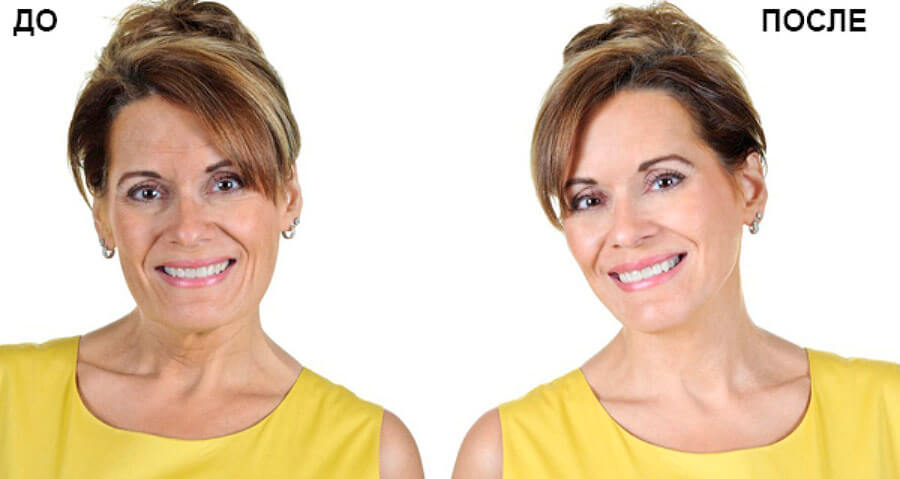 Безоперационное омоложение фото до после