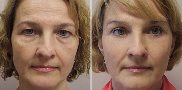 Фото до&nbsp;после подтяжки лба