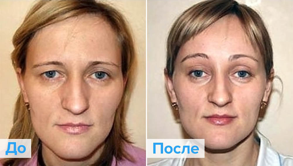 Подтяжка бровей фото до&nbsp;после