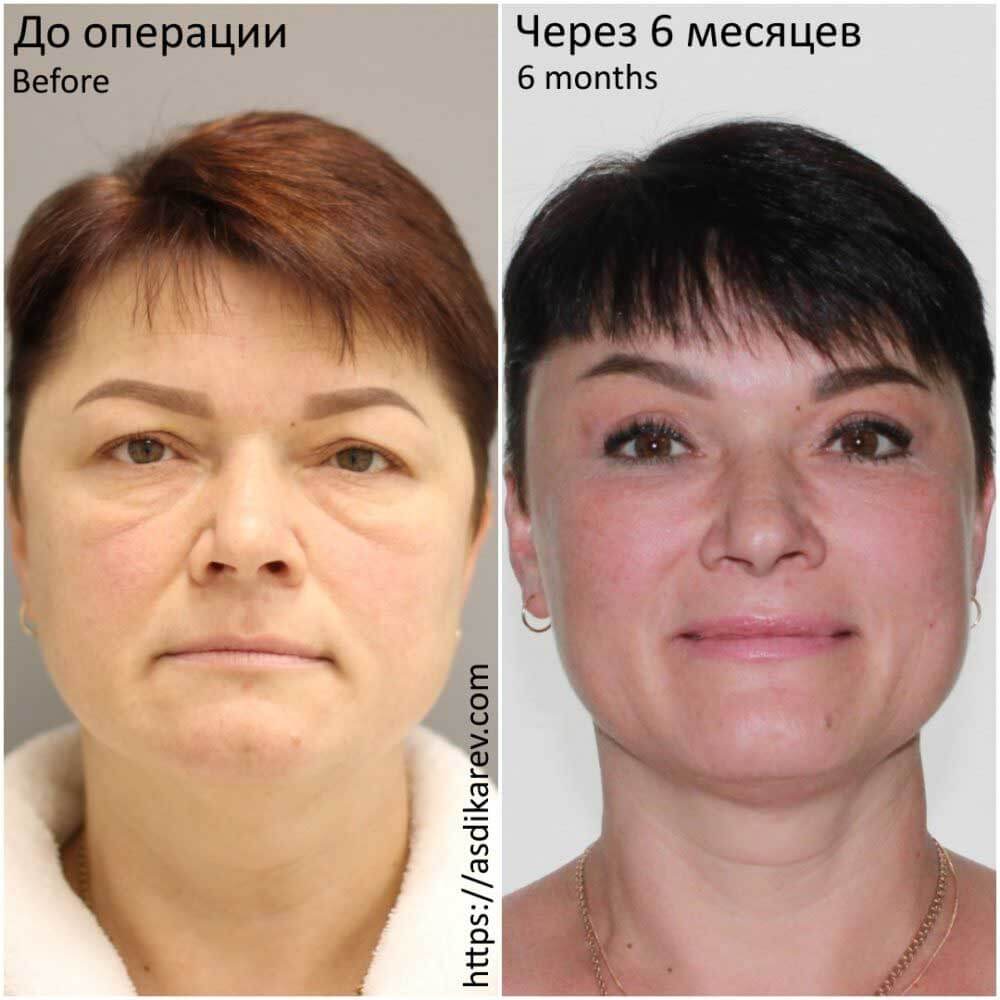 Фото до&nbsp;после подтяжки лба