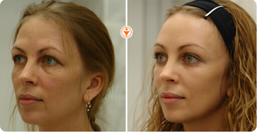 Фото до&nbsp;после подтяжки лба и&nbsp;бровей