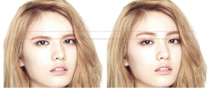 Эффект подтяжки лба и бровей фото до после