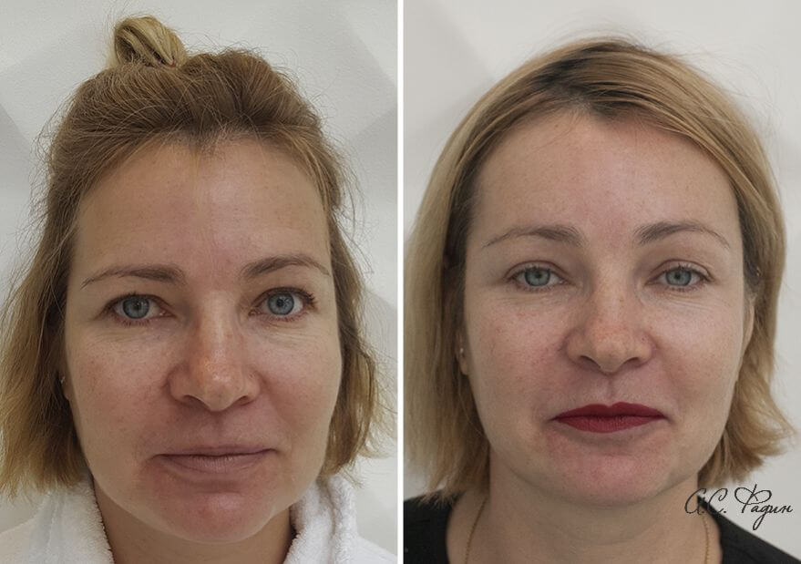 Фото до после подтяжки лба и бровей