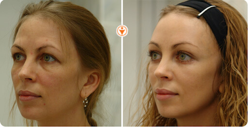 Подтяжка лба эндонитями фото до после