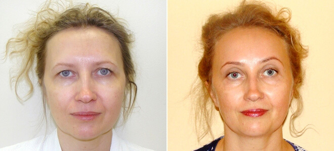 Естественный эффект подтяжки лба фото до после
