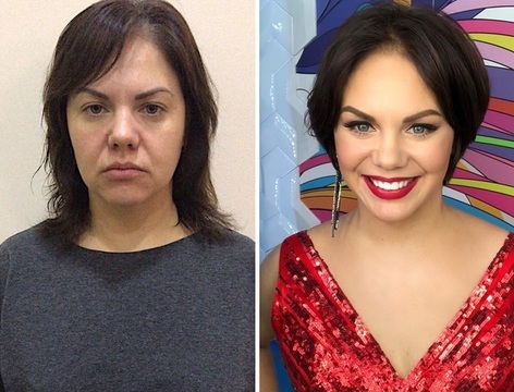 Эндоскопическая подтяжка щек: фото до после