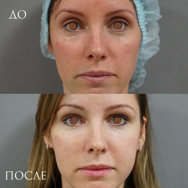 Подтяжка щек с липофилингом фото до после