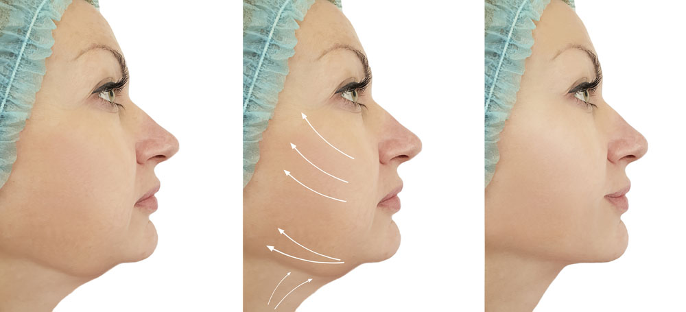 Фото до после подтяжки щек и подбородка