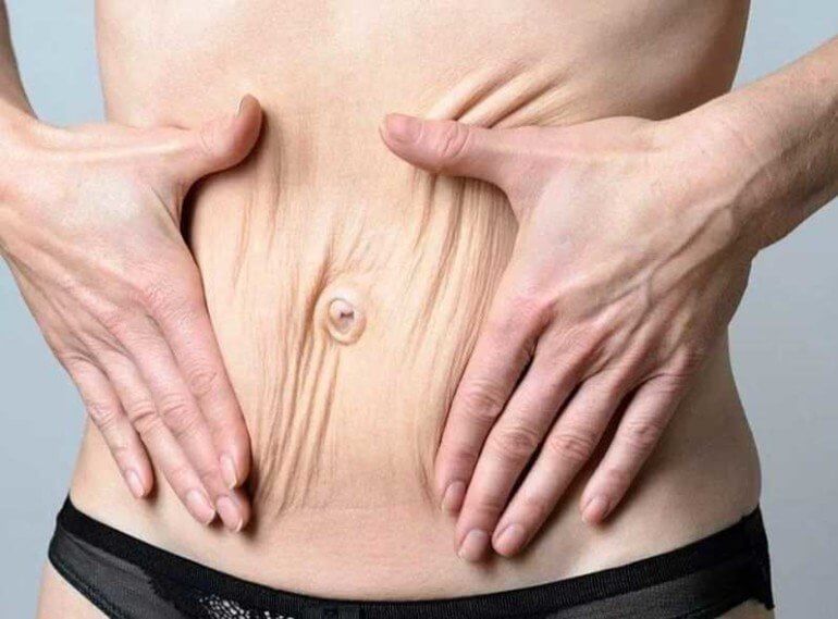 Липосакция убирает жир, кожу подтягивает другая процедура