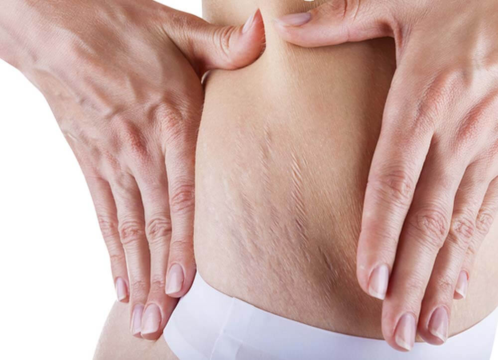 Липосакция &ndash; растяжки после процедуры фото