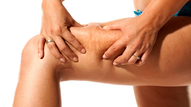 Целлюлит и&nbsp;липосакция