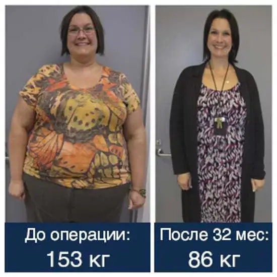 Фото до&nbsp;после бариатрической операции, липосакция такого эффекта не&nbsp;дает