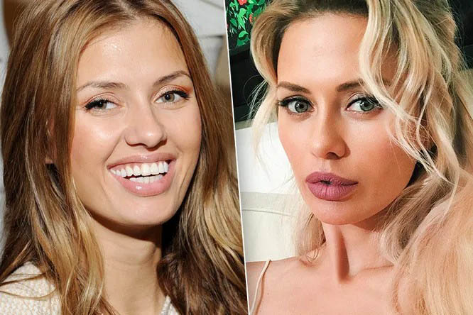 Виктория Боня: блефаропластика век фото до&nbsp;после