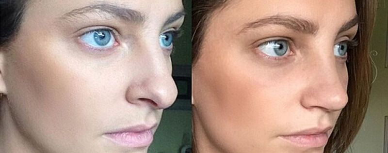 Ринопластика кончика носа фото до&nbsp;после