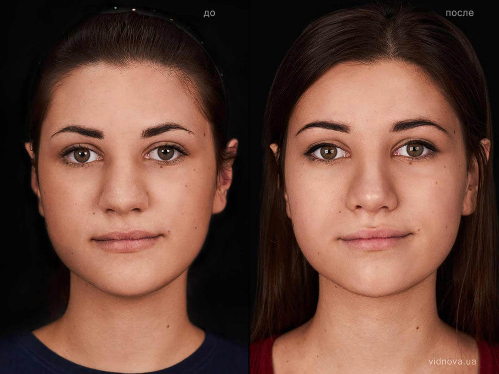 Фото до&nbsp;после ринопластики кончика носа