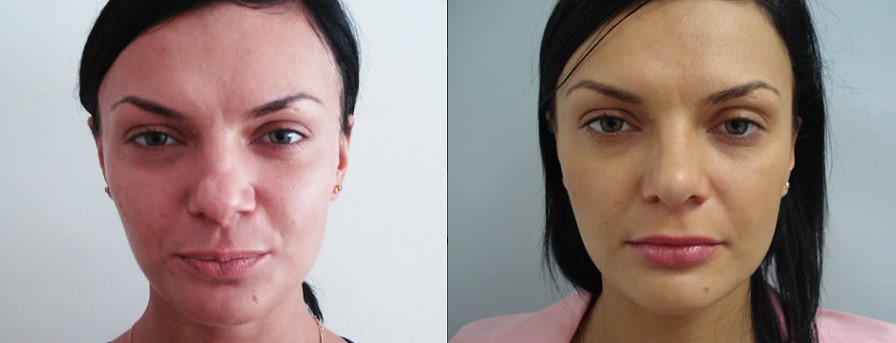 Фото до&nbsp;после ринопластики кончика