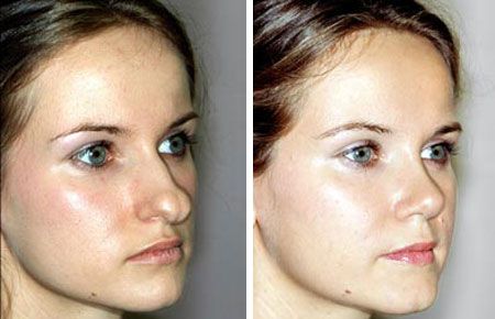 Фото до&nbsp;после ринопластики носа (кончика)