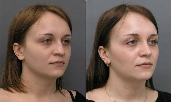 Пластика кончика носа фото до&nbsp;после