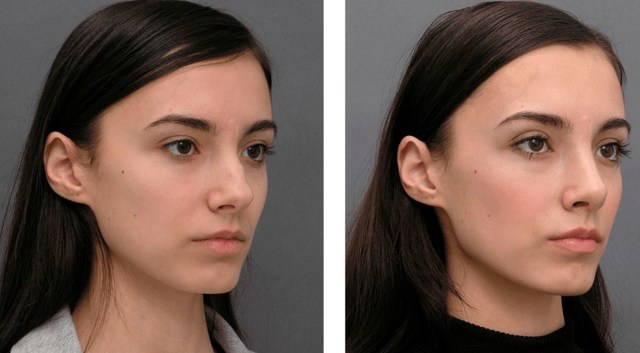 Ринопластика носа &ndash; фото до&nbsp;после