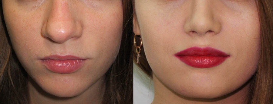 Ринопластика носа фото до&nbsp;после &ndash; работа с&nbsp;кончиком