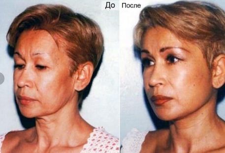Фото до&nbsp;после омоложения