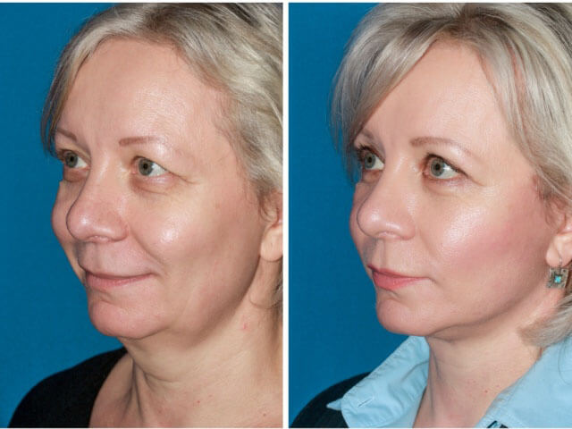 Фото до&nbsp;после омоложения лица