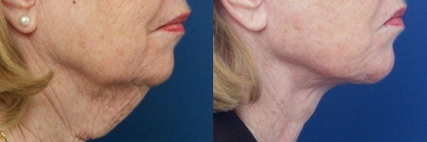 Омоложение шеи фото до&nbsp;после