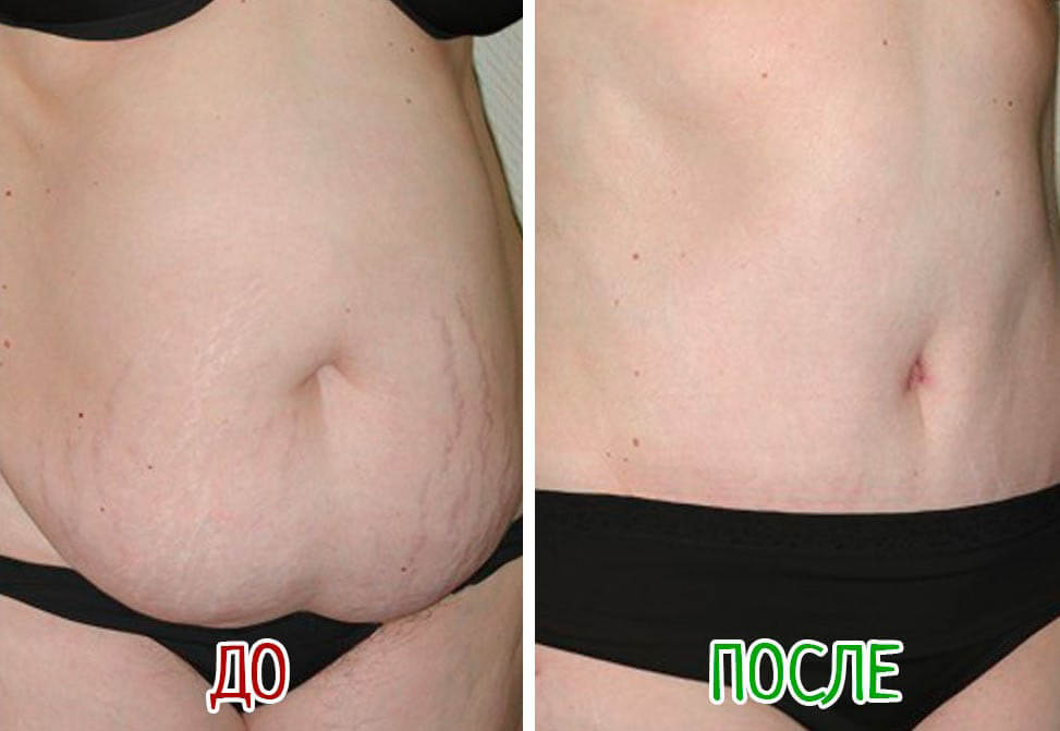 Фото до после абдоминопластики