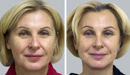 Эндоскопический лифтинг фото до после