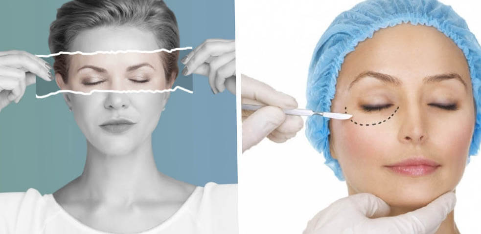 Блефаропластика и&nbsp;быстрое восстановление