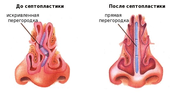 Септопластика: показания к&nbsp;процедуре?