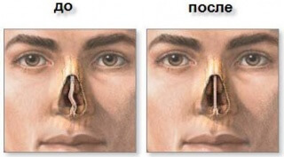до и&nbsp;после септопластики