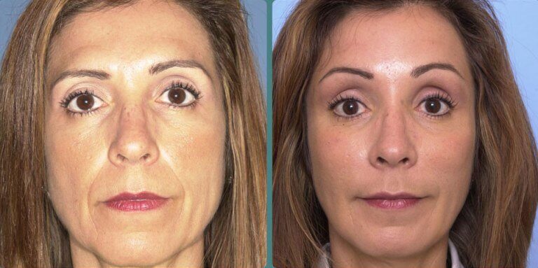 до и&nbsp;после процедуры SMAS-лифтинг