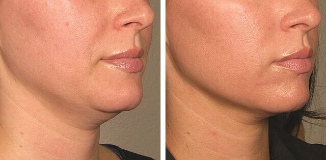 SMAS-лифтинг до&nbsp;и&nbsp;после