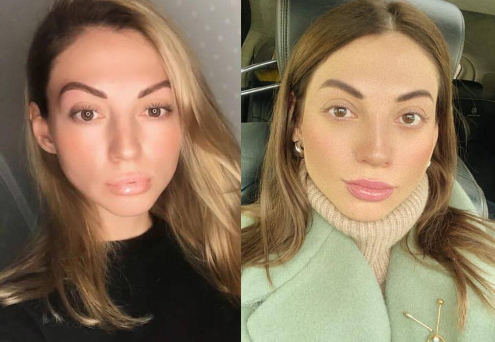 Смерть пациентки во время ринопластики в Москве